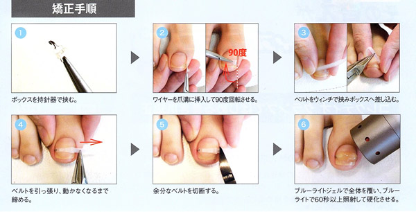 ワイヤー法（コレクティオクランプ）