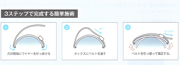 ワイヤー法(コレクティオクランプ)2